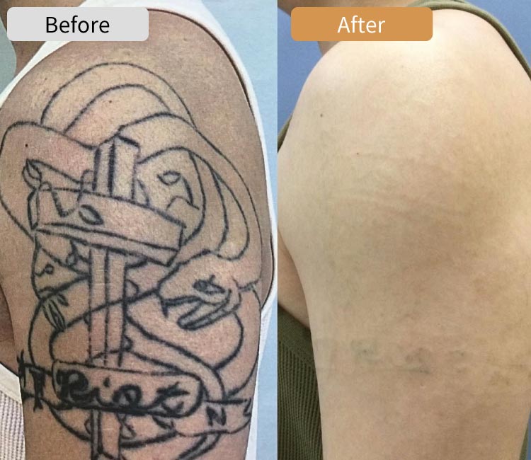 ピコレーザータトゥー除去症例