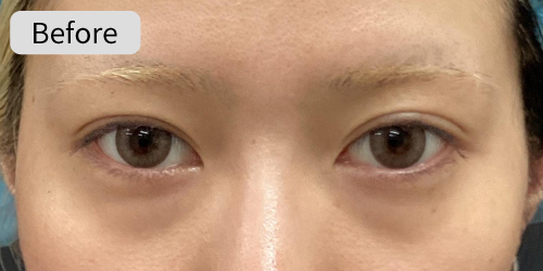 涙袋形成症例Before