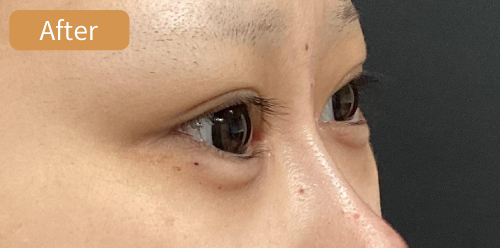 涙袋形成症例After