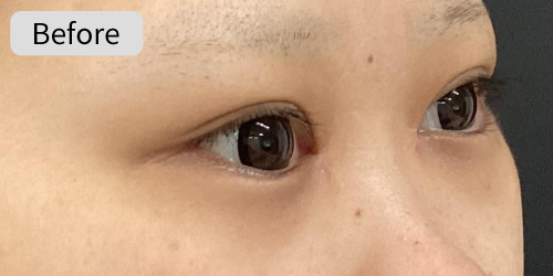 涙袋形成症例Before