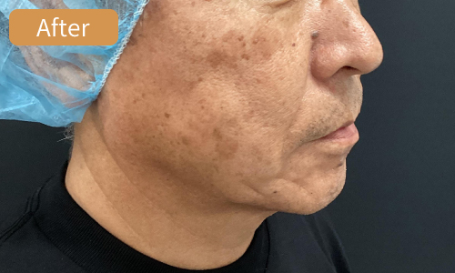 施術後サイド