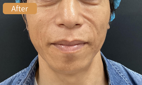 施術後