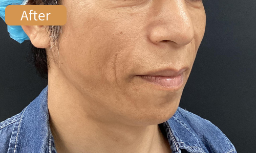 施術後サイド