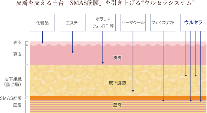 ウルセラとは