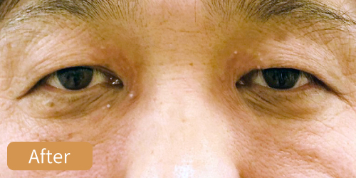 眼瞼黄色腫症例After