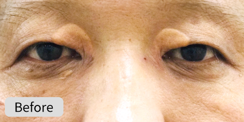 眼瞼黄色腫症例Before