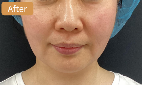 ザーフ症例04After