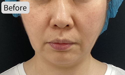 ザーフ症例04Before