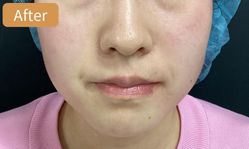 ザーフ症例05After