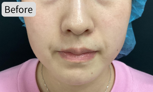 ザーフ症例05Before